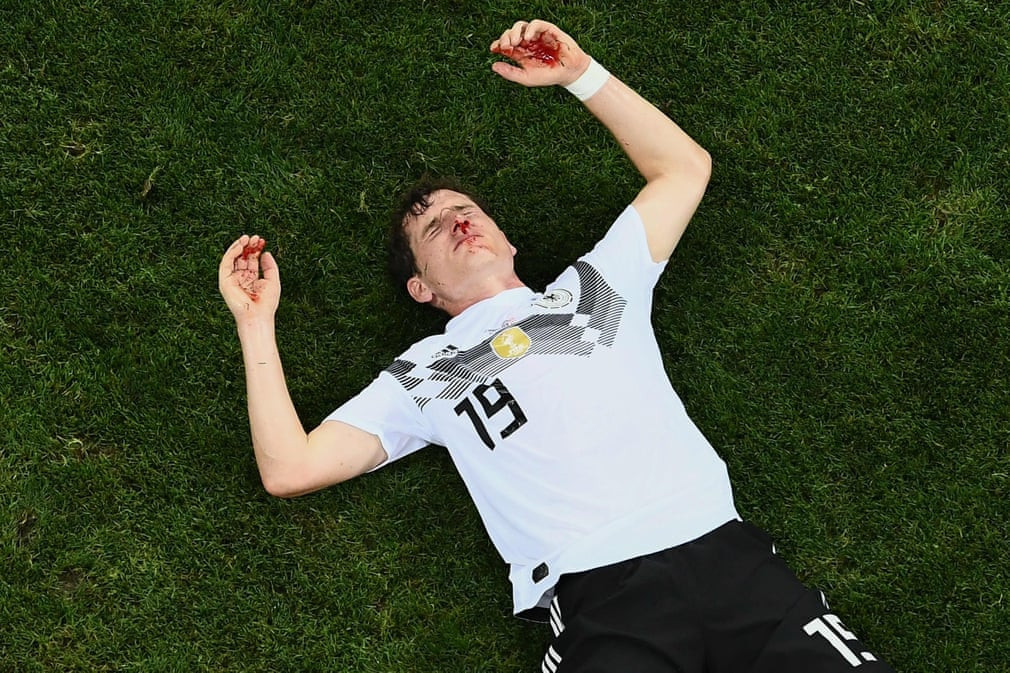 Germany midfielder Sebastian Rudy lies bloodied and awaits medical attention following a nasty collision against Sweden in Sochi ©Getty Images