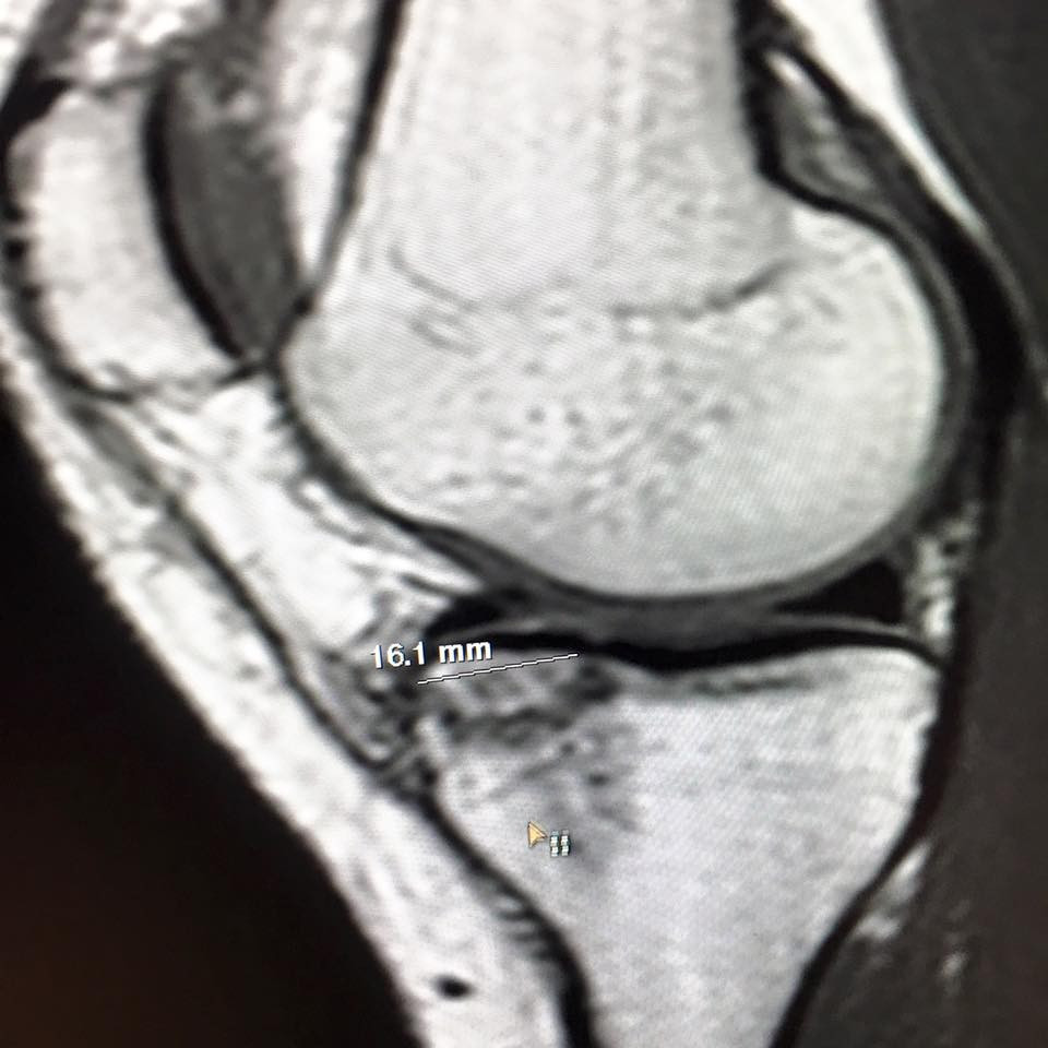 Lindsay Vonn posted a picture on Facebook of her MRI scan following the accident - showing a fractured in her tibial plateau - which has forced her to call an end to their season ©Facebook/Lindsay Vonn